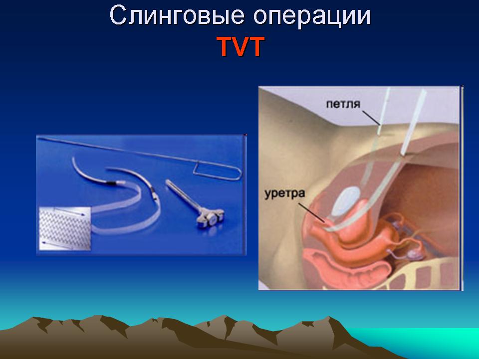 Слиноговые операции при недержании мочи Слиноговые операции при недержании мочи у женщин