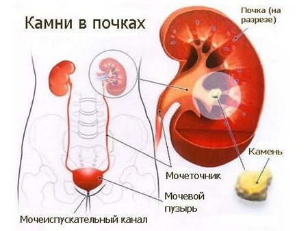 Что такое Тестикулярный микролитиаз в почках Что такое Тестикулярный микролитиаз