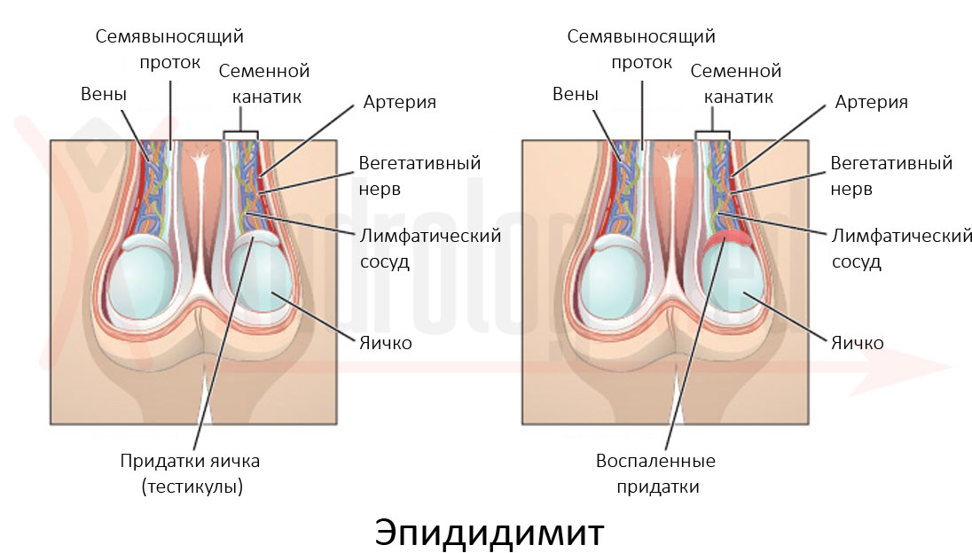 Виды заболевания Разновидности эпидидимита