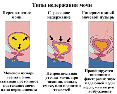 Классификация заболевания Классификация недержания мочи