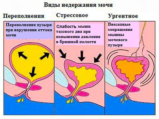 Виды и классификация заболевания Классификация заболевания