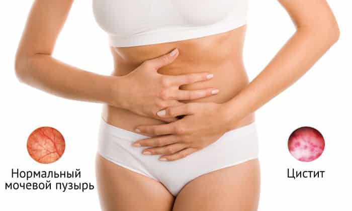 Что делать при цистите Заболевание мочевого пузыря