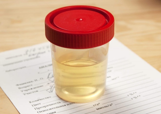 анализ мочи анализ мочи при цистите