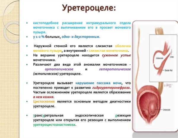 Что нужно знать о заболевании Уретероцеле Что нужно знать о заболевании