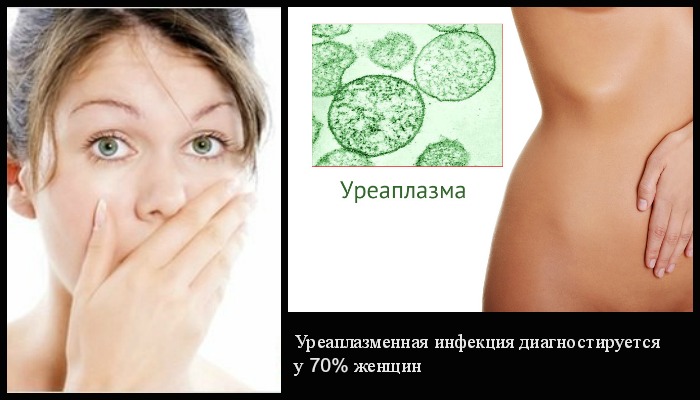 Что такое Уреаплазмоз у женщин Что такое Уреаплазмоз