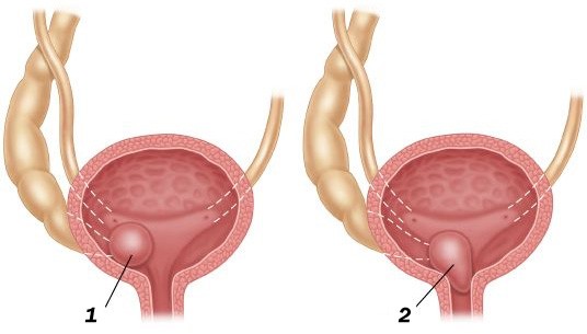 Как выглядит Уретероцеле у женщин Как выглядит Уретероцеле