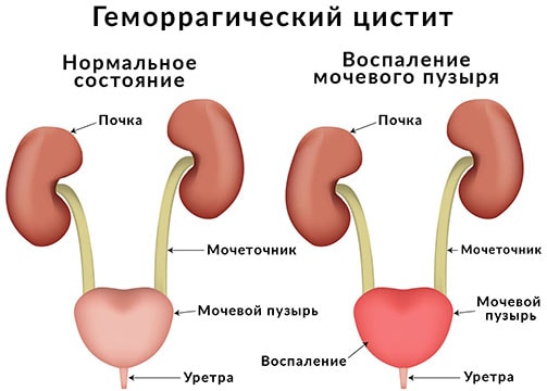 Как выглядит геморрагический цистит геморрагический цистит