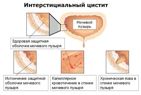 Как выглядит хронический цистит Что такое хронический цистит