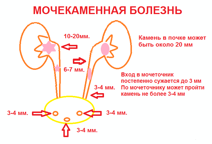 Что такое мочекаменная болезнь Из-за чего возникает мочекаменная болезнь
