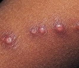 Болезнь паховая гранулема у женщин и мужчин Болезнь паховая гранулема