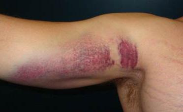 Что такое рабдомиолиз рабдомиолиз