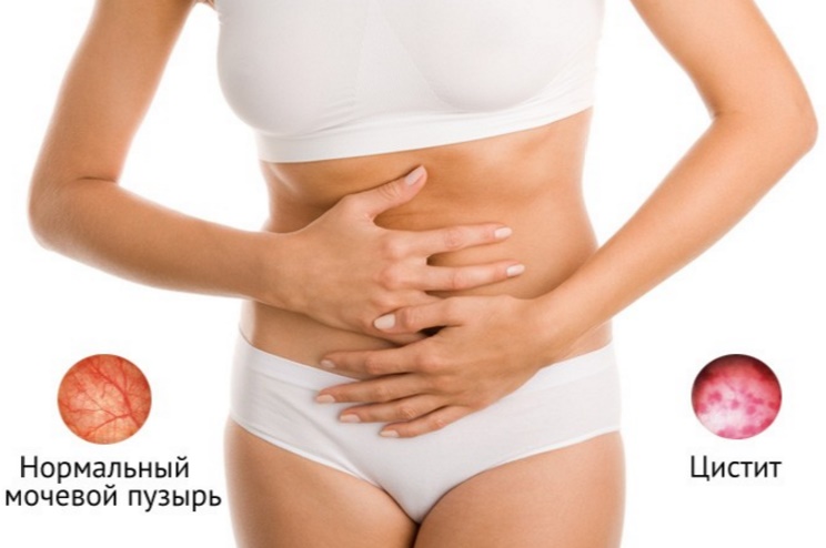 Как выявить заболевание Цистит Как выявить заболевание