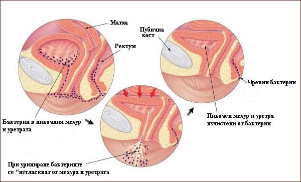 Что такое цистит Заболевание цистит