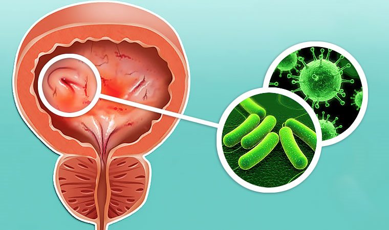 причина цистита у девочек причина цистита