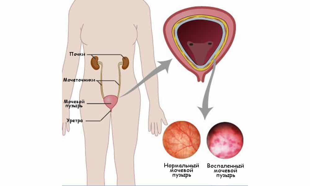 Что такое цистит у женщин Что такое цистит