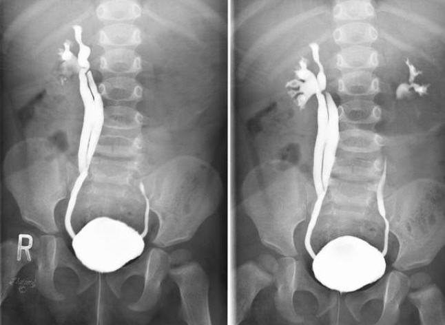 Снимок УЗИ - Пузырно-мочеточниковый рефлюс Снимок УЗИ