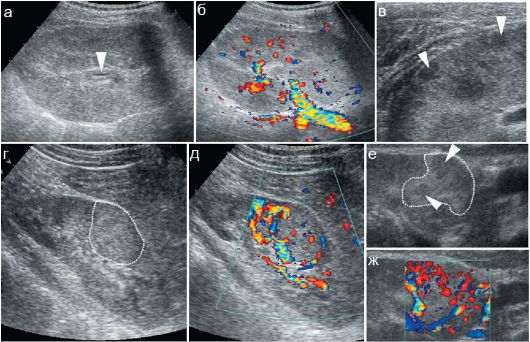 Как выявить на УЗИ заболевание Пиелонефрит Диагностика на узи