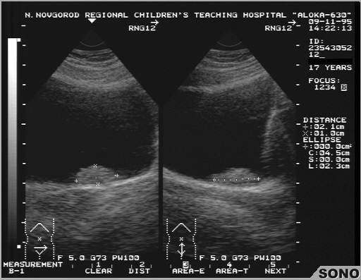 Диагностика полипов мочевого пузыря Диагностика