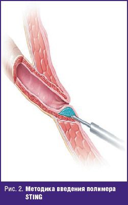 Метод лечения Пузырно-мочеточниковый рефлюкс Метод лечения