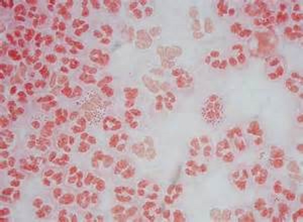 Как объяснить болезнь паховой гранулемы Как объяснить паховую гранулему