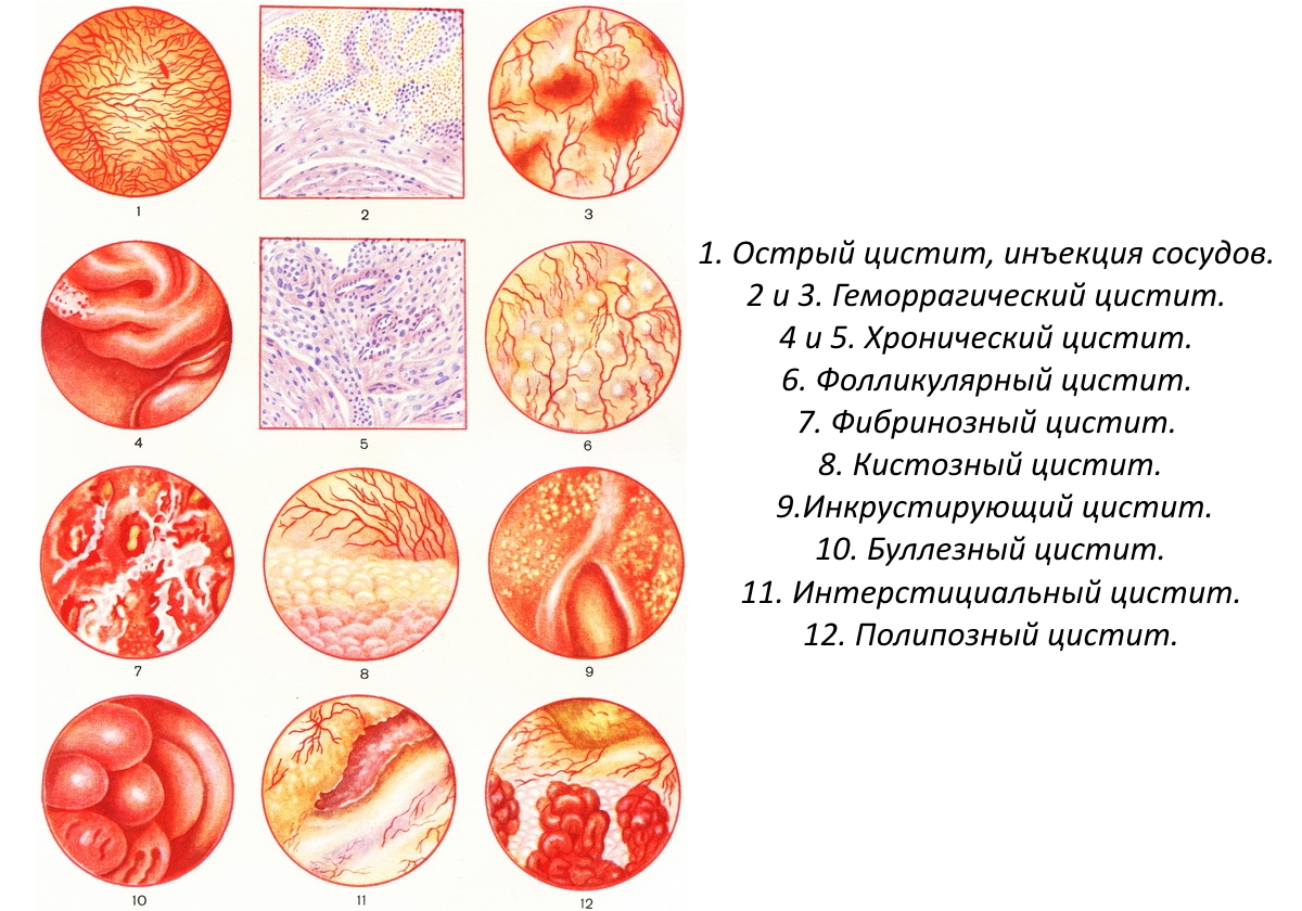 Как определить хронический цистит Как определить