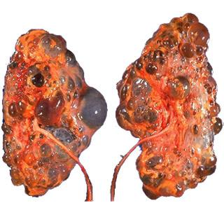 Вид почек при хроническом пиелонефрите Вид почек