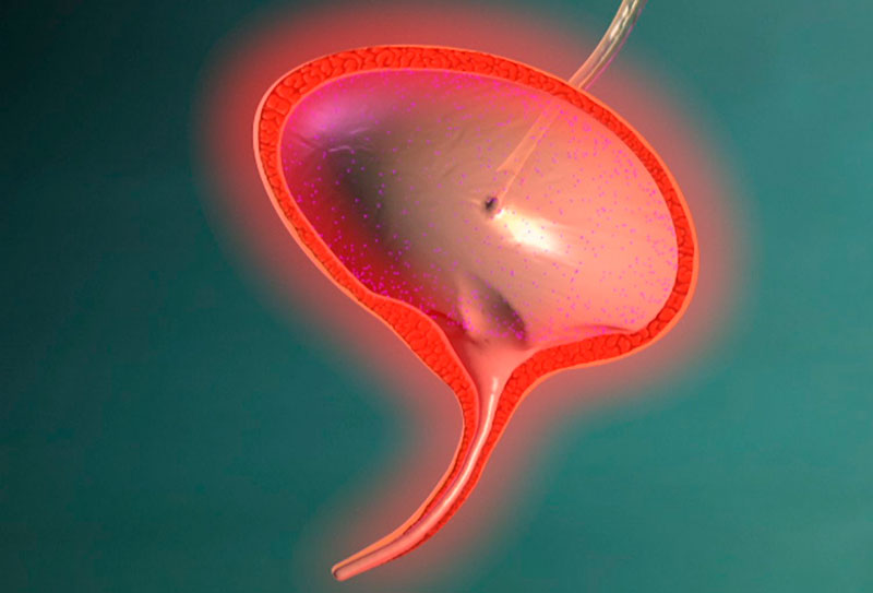 Что такое цистит у мужчин Что такое цистит