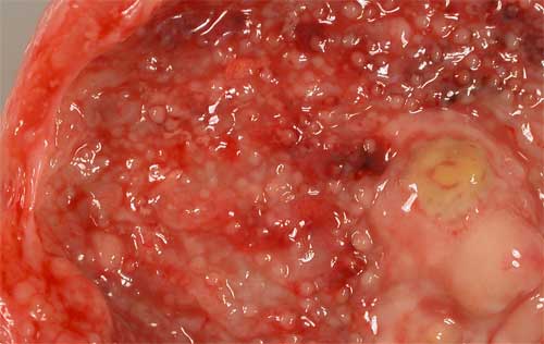 Как выглядит хронический цистит Как выглядит цистит