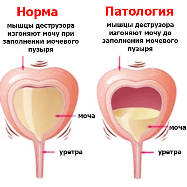 Как выявить дефекты детрузора мочевого пузыря Как выявить детрузор