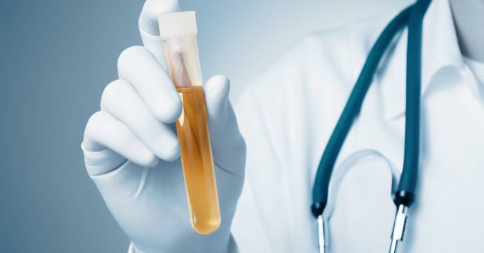 Какие анализы нужно сдавать при пиелонефрите Анализы мочи