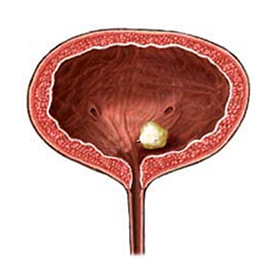 Камни в мочевом пузыре способствуют развитие цистита Камни в мочевом пузыре