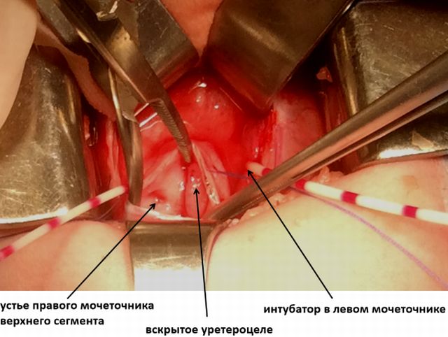 Как лечится уретероцеле Лечение уретероцеле