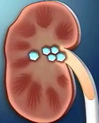 Что такое Микролитиаз в почках Микролитиаз