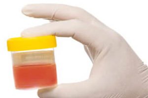 Моча с кровью - один из симптомов Цистита Моча с кровью