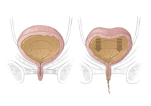 Болезнь нейрогенный мочевой пузырь Что такое нейрогенный мочевой пузырь