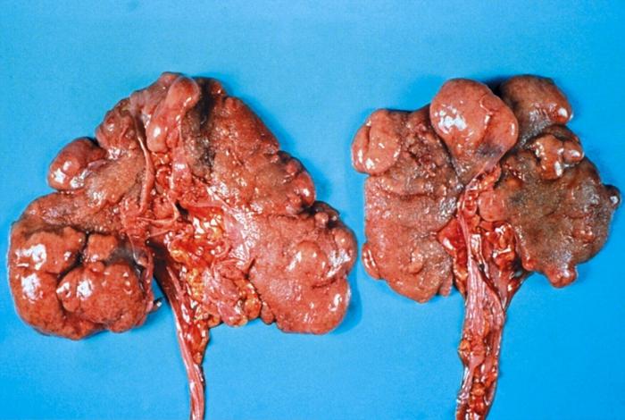 Почка при хроническом пиелонефрите Почка при хроническом