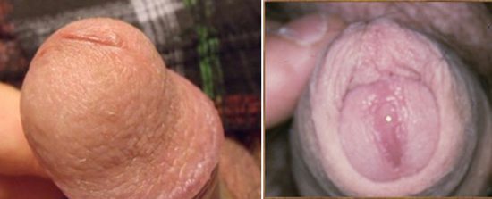 Особенности протекание болезни Уреаплазмоз у мужчин Особенности протекание болезни