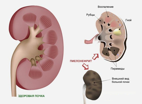 Что такое Пиелонефрит у детей Что такое Пиелонефрит