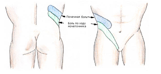 Проявление боли при мочекаменной болезни Проявление боли