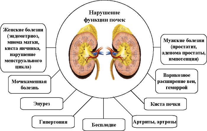 Последствия пиелонефрита для мужчин Последствия пиелонефрита