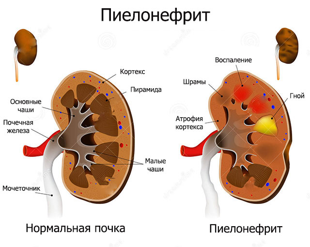 Признаки болезни обструктивного пиелонефрита Признаки болезни