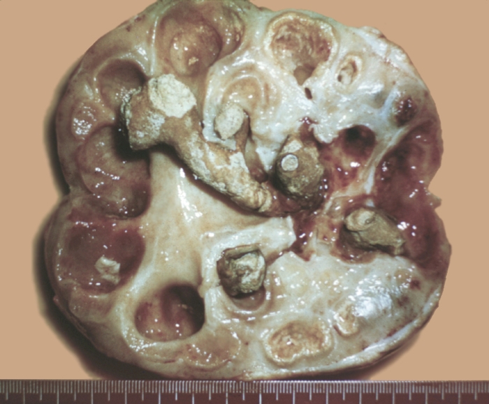 настоящая почка с камнями настоящая почка