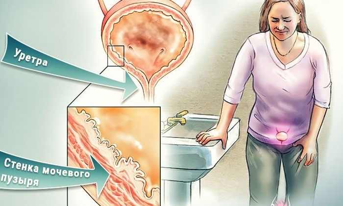 Симптомы заболевания Геморрагического цистита Симптомы Геморрагический цистит