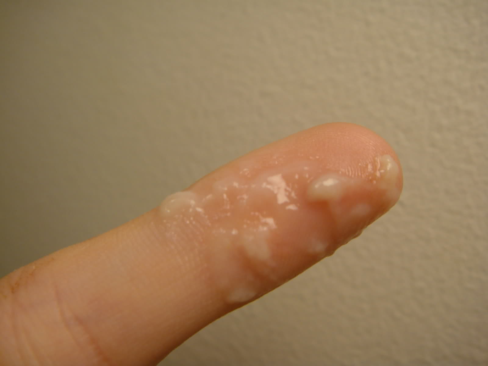 Симптомы уретрита у женщин Симптомы уретрита