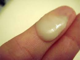 Симптомы заболевания Уретрит Симптомы заболевания