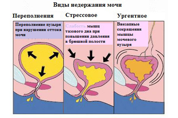 Симптомы Детрузора Симптомы