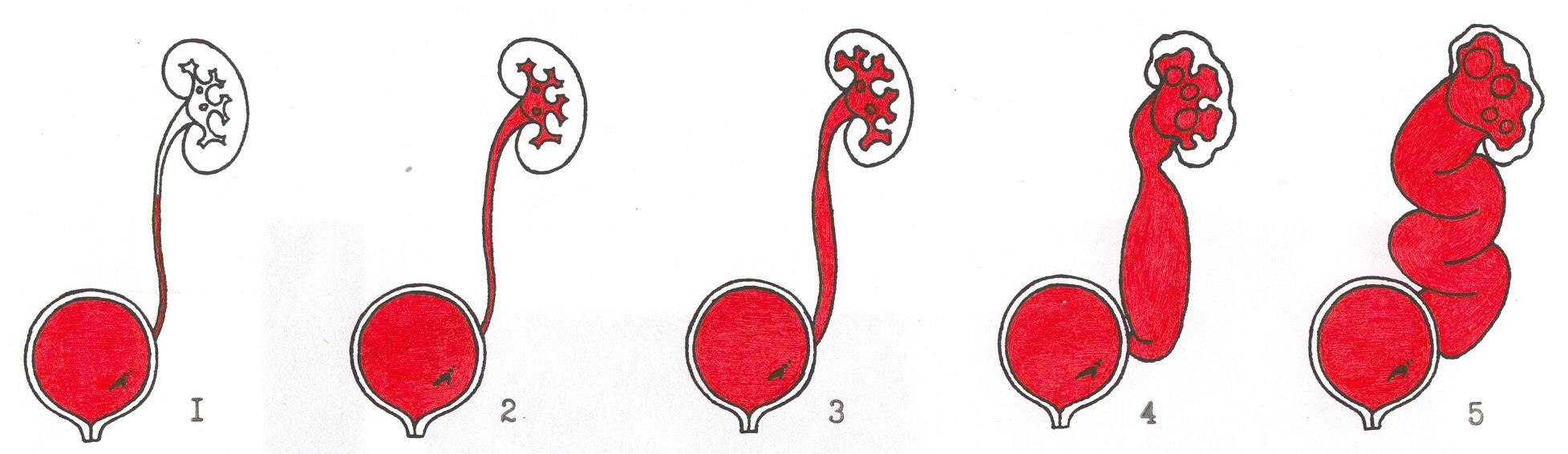 Стадии развития Пузырно-мочеточниковый рефлюса Стадии развития болезни