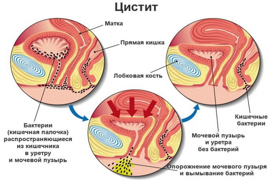 Цистит входит в заболевания МПС Цистит