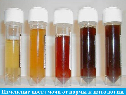 Виды заболевания гемоглобинурия Виды заболевания