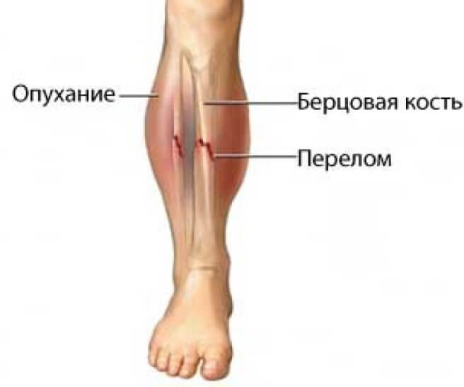 Перелом голени
